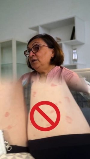 Псориаз — как система раннего оповещения: всё на поверхности