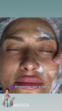 Устранение впадин под глазами