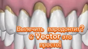 Лечение парадонтита на аппарате Vector
