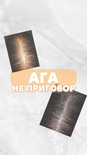 💡Если у вас андрогенетическая алопеция - не поддавайтесь панике: процесс можно контролировать!