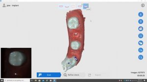 Интраоральный сканер Runyes IoS-11 – пример 3D-сканирования зубного ряда №4