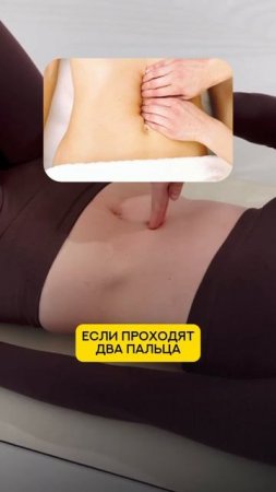 🤰 Диастаз после родов — это нормально?