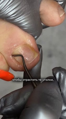 Кюретка — это не просто «почистить», а убрать всё лишнее так, чтобы ноготь не врастал и не давил.
