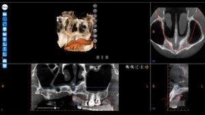 TEMSTargeted Endodontic Microsurgery Guide Workflow [get-save.com] (1)
