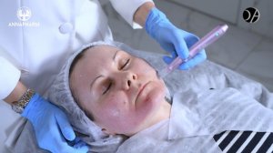 PURASOMES AMPLEX+ SGC100+ | Применение в сочетании с Dermapen