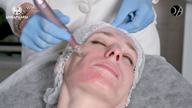 PURASOMES AMPLEX NC150  Применение в сочетании с Dermapen