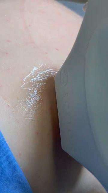 BBL Forever Clear: лечение акне смотреть онлайн