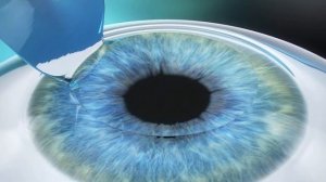 Super LASIK - визуализация процесса коррекции зрения