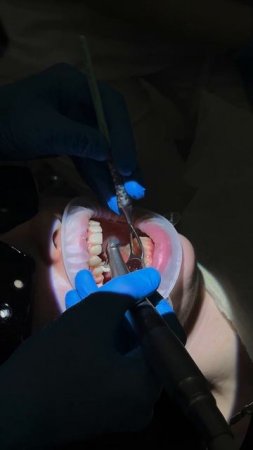 Работа с микроскопом стоматология Видентис #стоматология #стоматологиямск #dentist