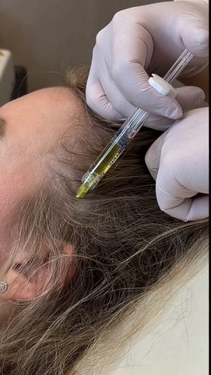 Инъекционная процедура препаратом Hair X (DNA Peptide), как профилактика роста волос.