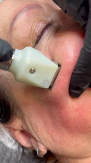 Радиочастотный лифтинг Fractora смотреть онлайн