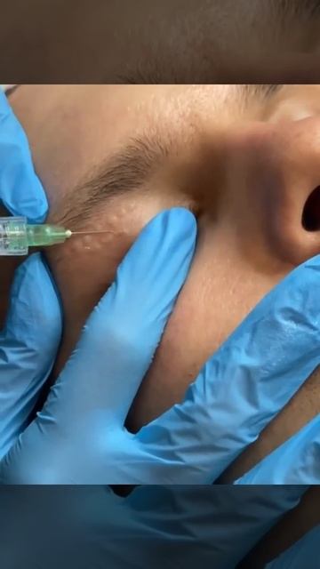 Биоревитализация REVI смотреть онлайн