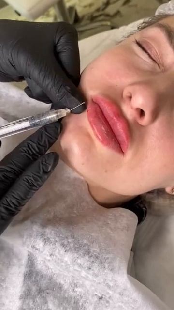 Контурная пластика губ смотреть онлайн