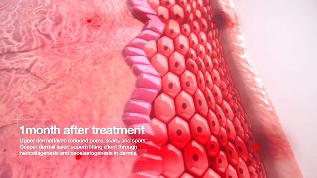 Микроигольчатый RF-лифтинг Scarlet смотреть онлайн