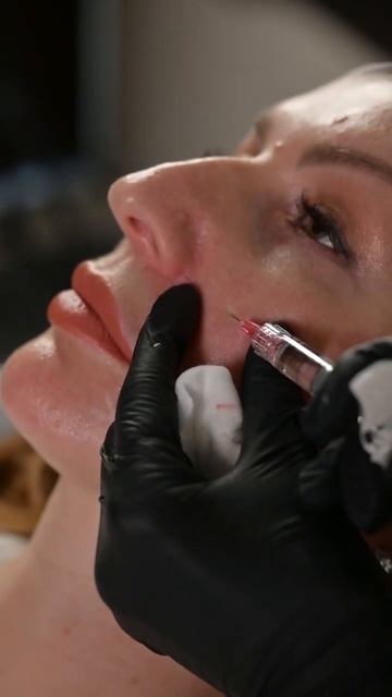 Биоревитализация BioHyalux Rejuven 25 смотреть онлайн