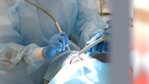 Кариес под пломбой: невидимое вторжение (вторичный кариес)