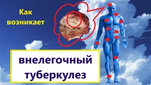 Как возникает внелегочный туберкулез
