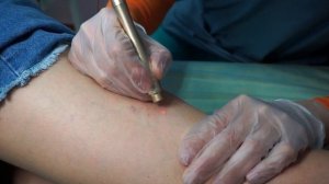 Лазерное Удаление Сосудиков На Ногах