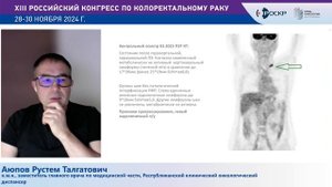 Изолированные парааортальные метастазы
колоректального рака
Аюпов Рустем Талгатович