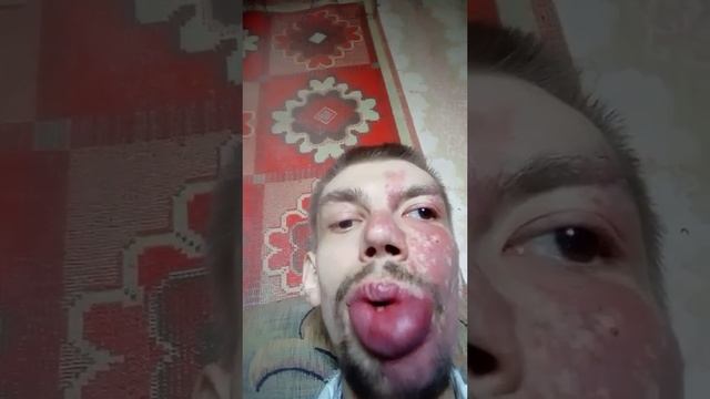 Верхнюю губу наверное хочет подкачать