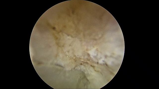 Рецидив грыжи L5. Эндоскопическое удаление грыжи L5 диска. (Re UBE L5-S1). Анонс. смотреть онлайн