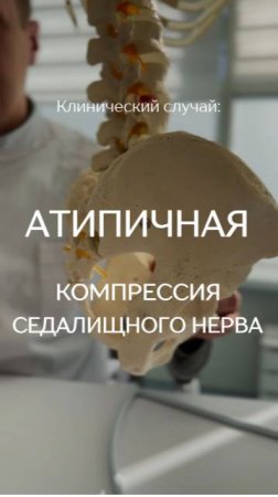Атипичная компрессия седалищного нерва