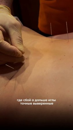 Зачем вообще ставить иглы?