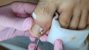 Вросший ноготь после травмы/ установка тампонады