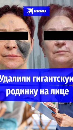 Гигантскую родинку на пол-лица удалили у женщины в Ставрополе. Она могла стать злокачественной