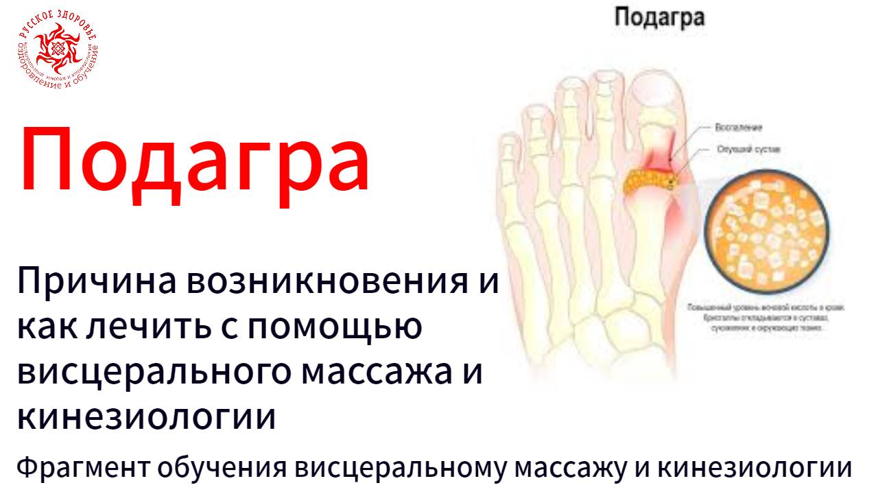 Подагра. Причина возникновения и как лечить с помощью висцерального массажа и кинезиологии.