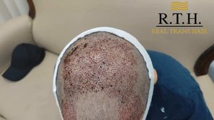 Результат сразу после пересадки
