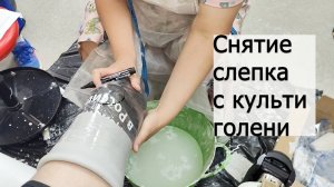 Снятие гипсового слепка с культи голени
