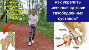 Придушенная артерия шейки бедра не может кормить тазобедренный сустав. Методы декомпрессии