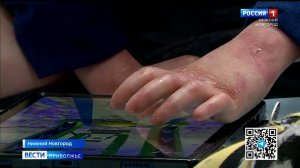 Федеральные эксперты обсудили помощь детям с редким генетическим заболеванием кожи