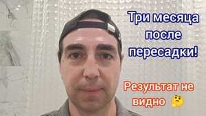 Три месяца после пересадки. Пересадка волос в Санкт-Петербурге.