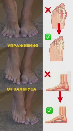 Упражнения от вальгуса. Подпишись и читай описание ✅
