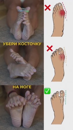 Убери косточку на ноге. Подпишись и читай описание✅