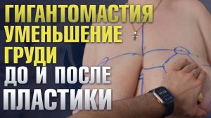 Уменьшение груди (редукционная маммопластика). Гигантомастия | Пластический хирург Саввин Олег