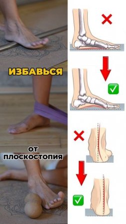 Избавься от плоскостопия. Подпишись и читай описание ✅