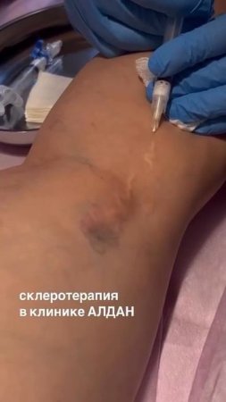 Склеротерапия в клинике "Алдан"