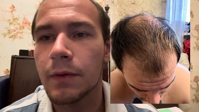 Пересадка волос | 4 месяца после пересадки волос