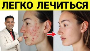 ИЗБАВЬТЕ СЕБЯ ОТ ПРЫЩЕЙ.