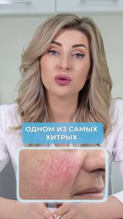 Как распознать РОЗАЦЕА вовремя? #покраснение #чистаякожа #розацеа