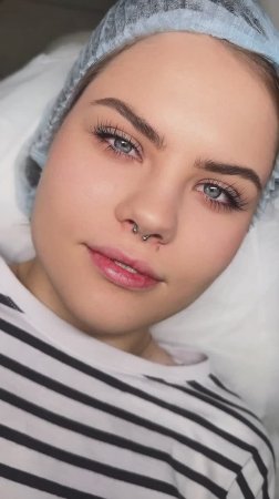 ФОТООМОЛОЖЕНИЕ M22: Убираем звёздочки и пигментацию за 1 процедуру! Реальные результаты