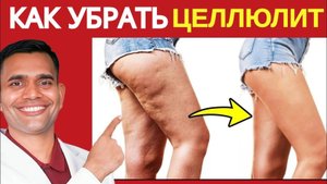 КАК ВЫЛЕЧИТЬ ЦЕЛЛЮЛИТ?