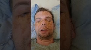Как убрать отёк и синяк с лица быстро - самые действенные средства