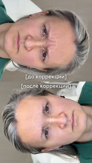 Пациентку беспокоили мимические морщины.