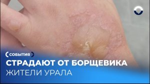 Как борщевик Сосновского вызывает опасные ожоги на коже