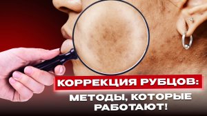 Постакне и рубцы: лучшие методы коррекции от косметолога