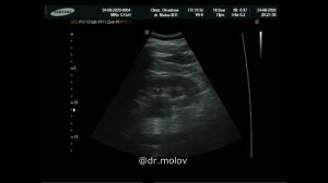 Стент в мочеточнике на УЗИ